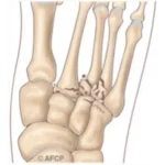 Fractures de Lisfranc