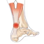 Rupture du tendon d’Achille