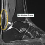 Tendinopathie du corps du tendon calcanéen