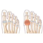 Hallux rigidus