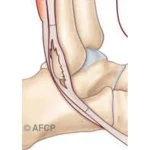 Pathologie des tendons fibulaires